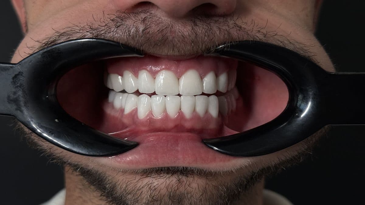Hollywood Smile pre i posle — keramičke fasete, JK Dental Clinic Beograd — posle
