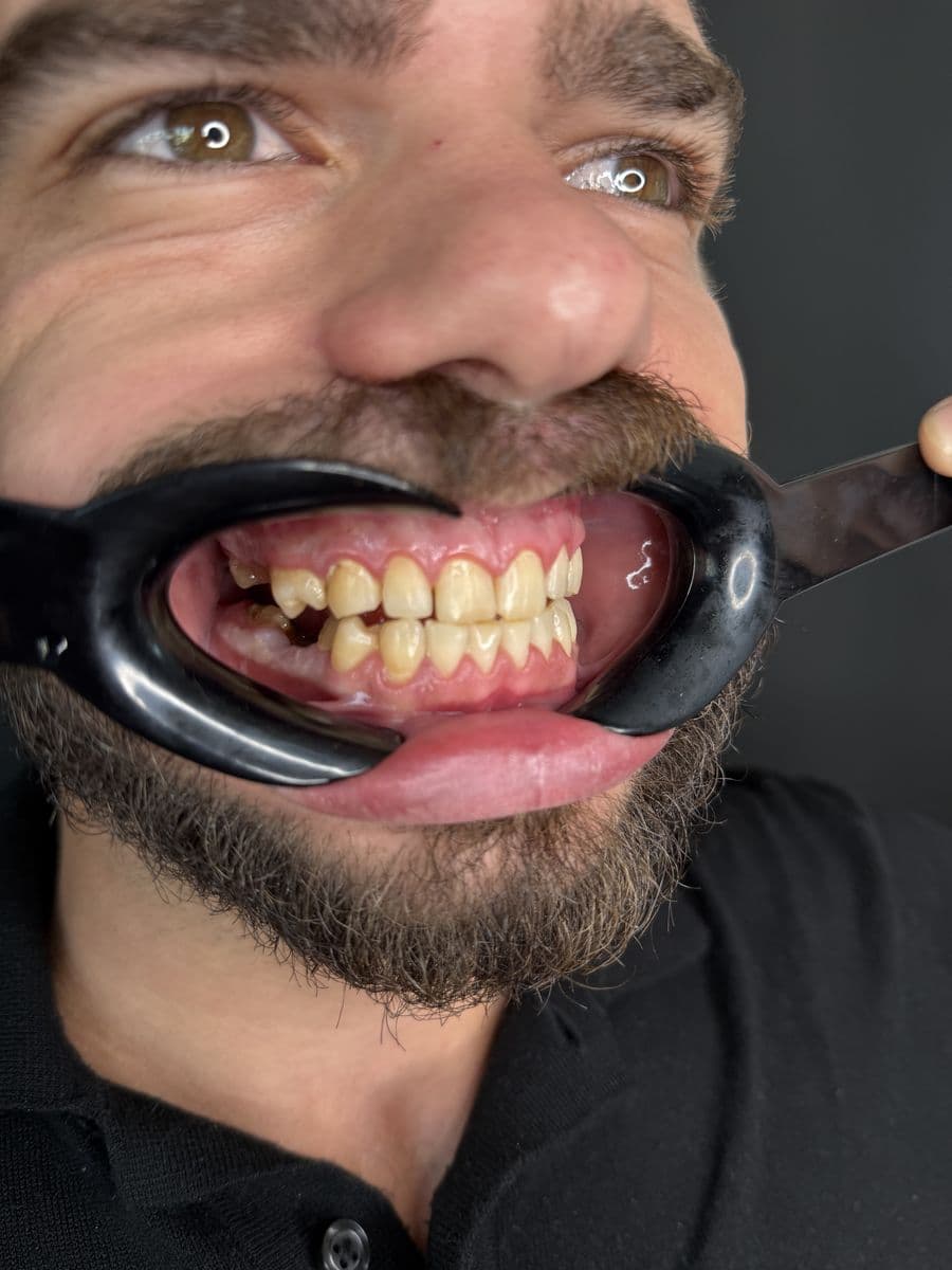 Hollywood Smile pre i posle — keramičke fasete, JK Dental Clinic Beograd — pre